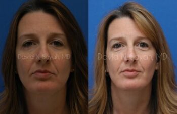 Rhinoplasty Before and After | Sayah Institute