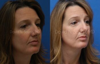 Rhinoplasty Before and After | Sayah Institute