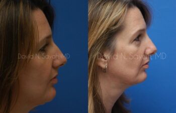 Rhinoplasty Before and After | Sayah Institute