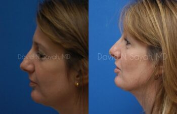 Rhinoplasty Before and After | Sayah Institute