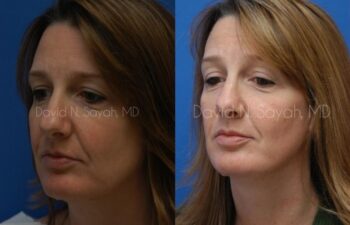 Rhinoplasty Before and After | Sayah Institute
