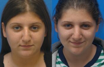 Rhinoplasty Before and After | Sayah Institute