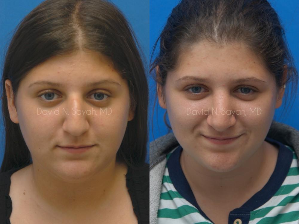 Rhinoplasty Before and After | Sayah Institute