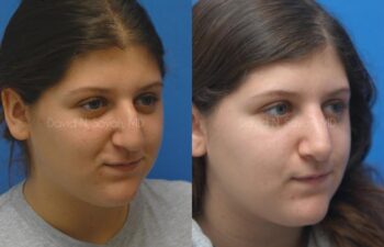 Rhinoplasty Before and After | Sayah Institute
