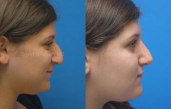 Rhinoplasty Before and After | Sayah Institute
