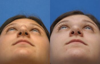 Rhinoplasty Before and After | Sayah Institute