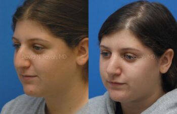 Rhinoplasty Before and After | Sayah Institute
