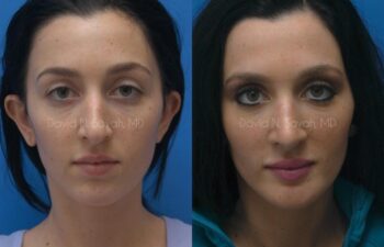 Rhinoplasty Before and After | Sayah Institute