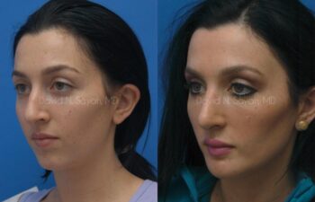 Rhinoplasty Before and After | Sayah Institute