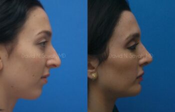 Rhinoplasty Before and After | Sayah Institute