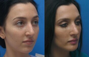 Rhinoplasty Before and After | Sayah Institute