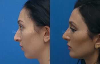 Rhinoplasty Before and After | Sayah Institute
