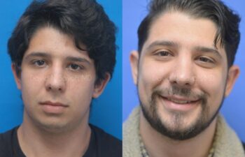 Rhinoplasty Before and After | Sayah Institute