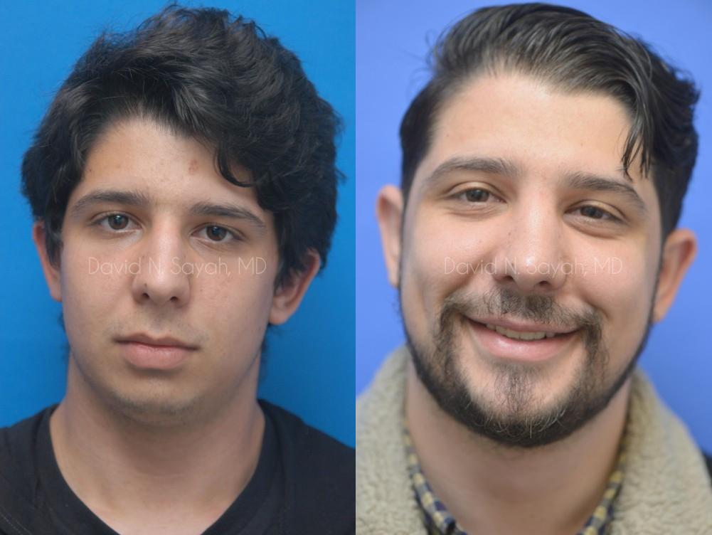 Rhinoplasty Before and After | Sayah Institute