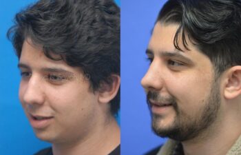Rhinoplasty Before and After | Sayah Institute