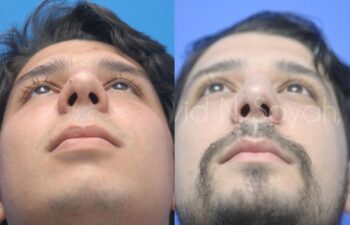 Rhinoplasty Before and After | Sayah Institute