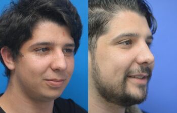 Rhinoplasty Before and After | Sayah Institute