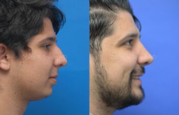 Rhinoplasty Before and After | Sayah Institute