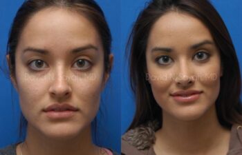 Rhinoplasty Before and After | Sayah Institute