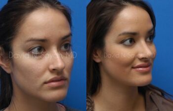 Rhinoplasty Before and After | Sayah Institute