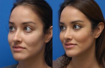 Rhinoplasty Before and After | Sayah Institute