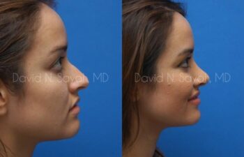 Rhinoplasty Before and After | Sayah Institute