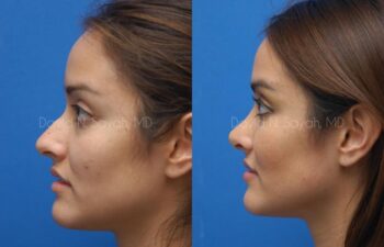 Rhinoplasty Before and After | Sayah Institute