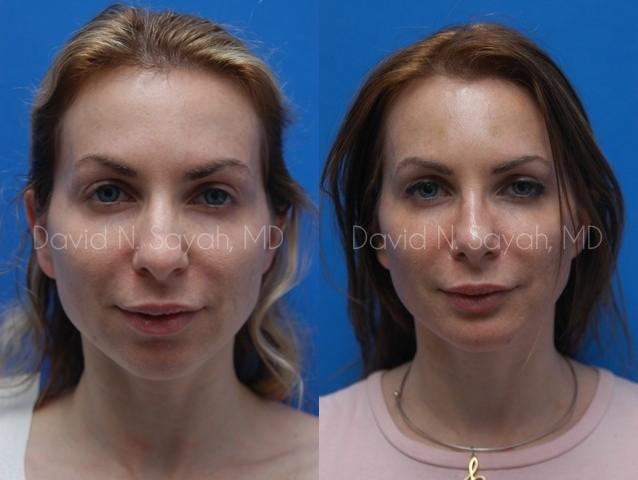 Chin Implant Before and After | Sayah Institute