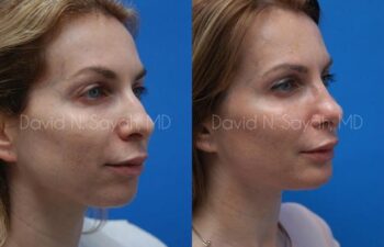 Chin Implant Before and After | Sayah Institute