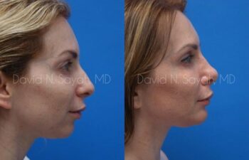 Chin Implant Before and After | Sayah Institute