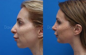 Chin Implant Before and After | Sayah Institute