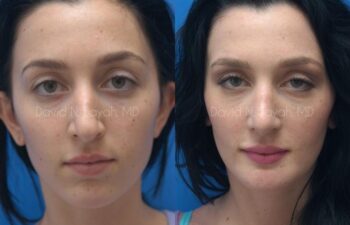 Chin Implant Before and After | Sayah Institute