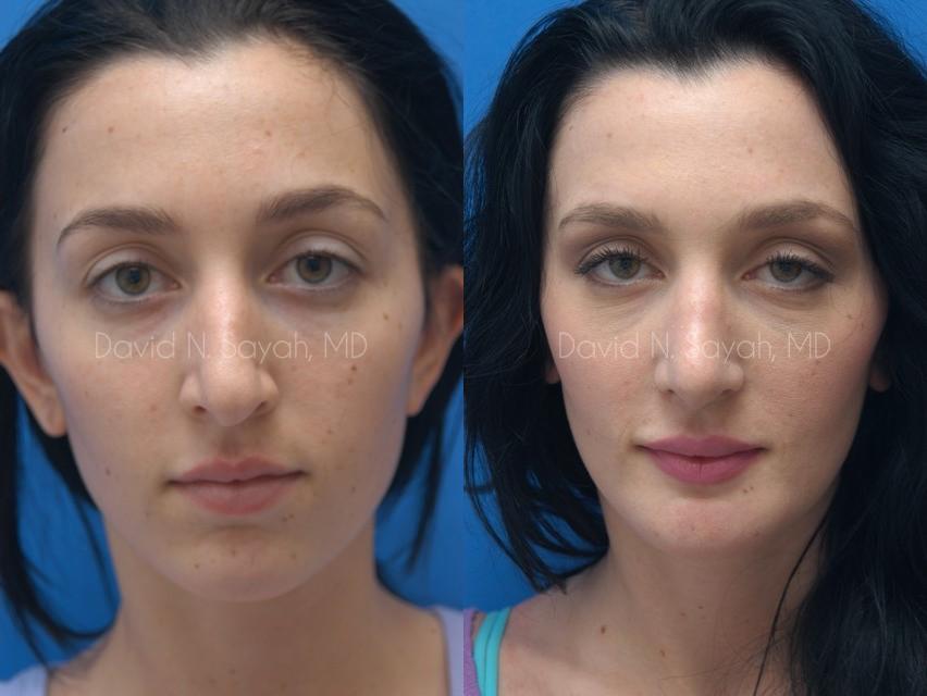 Chin Implant Before and After | Sayah Institute