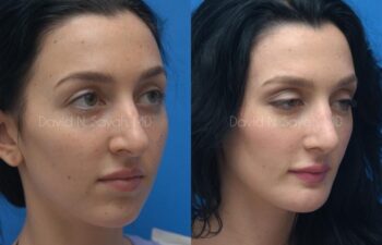 Chin Implant Before and After | Sayah Institute