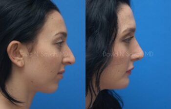 Chin Implant Before and After | Sayah Institute