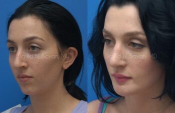 Chin Implant Before and After | Sayah Institute