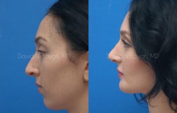Chin Implant Before and After | Sayah Institute