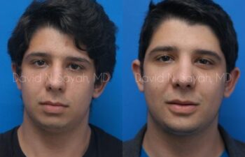Chin Implant Before and After | Sayah Institute