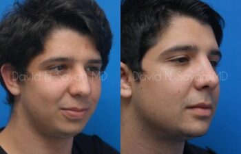 Chin Implant Before and After | Sayah Institute