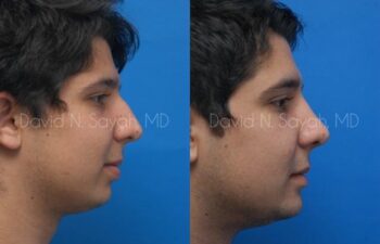 Chin Implant Before and After | Sayah Institute