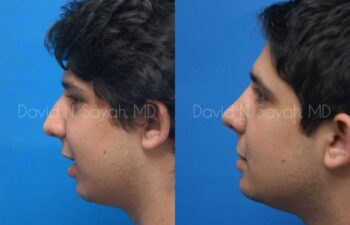 Chin Implant Before and After | Sayah Institute