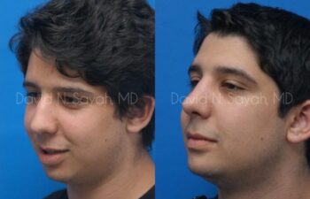 Chin Implant Before and After | Sayah Institute