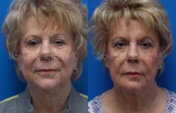Chin Implant Before and After | Sayah Institute