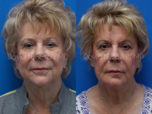 Chin Implant Before and After | Sayah Institute