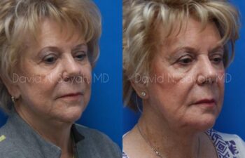 Chin Implant Before and After | Sayah Institute