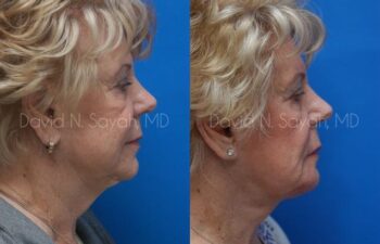Chin Implant Before and After | Sayah Institute
