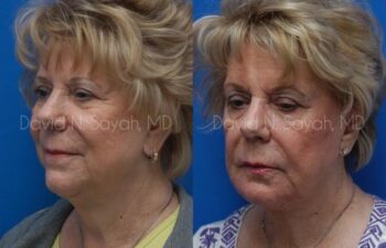 Chin Implant Before and After | Sayah Institute