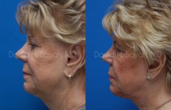 Chin Implant Before and After | Sayah Institute