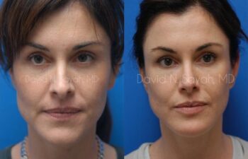 Chin Implant Before and After | Sayah Institute