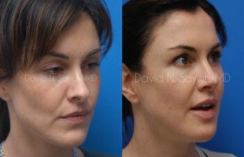Chin Implant Before and After | Sayah Institute